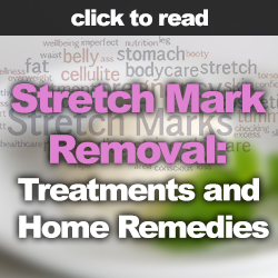 Click here to read - Stretch Mark Removal: Treatments and Home Remedies